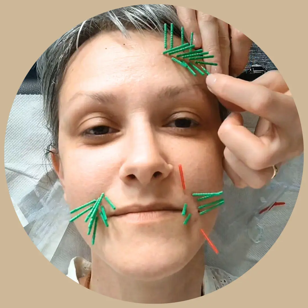 Akupunktura kosmetyczna Inowrocław